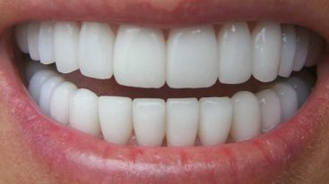 Comment est-on remboursé par sa complémentaire pour les soins dentaires ?