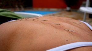 Comment suis-je remboursé pour une séance d’acupuncture ?