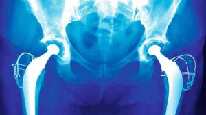 Ostéoporose : Prise en charge des traitements
